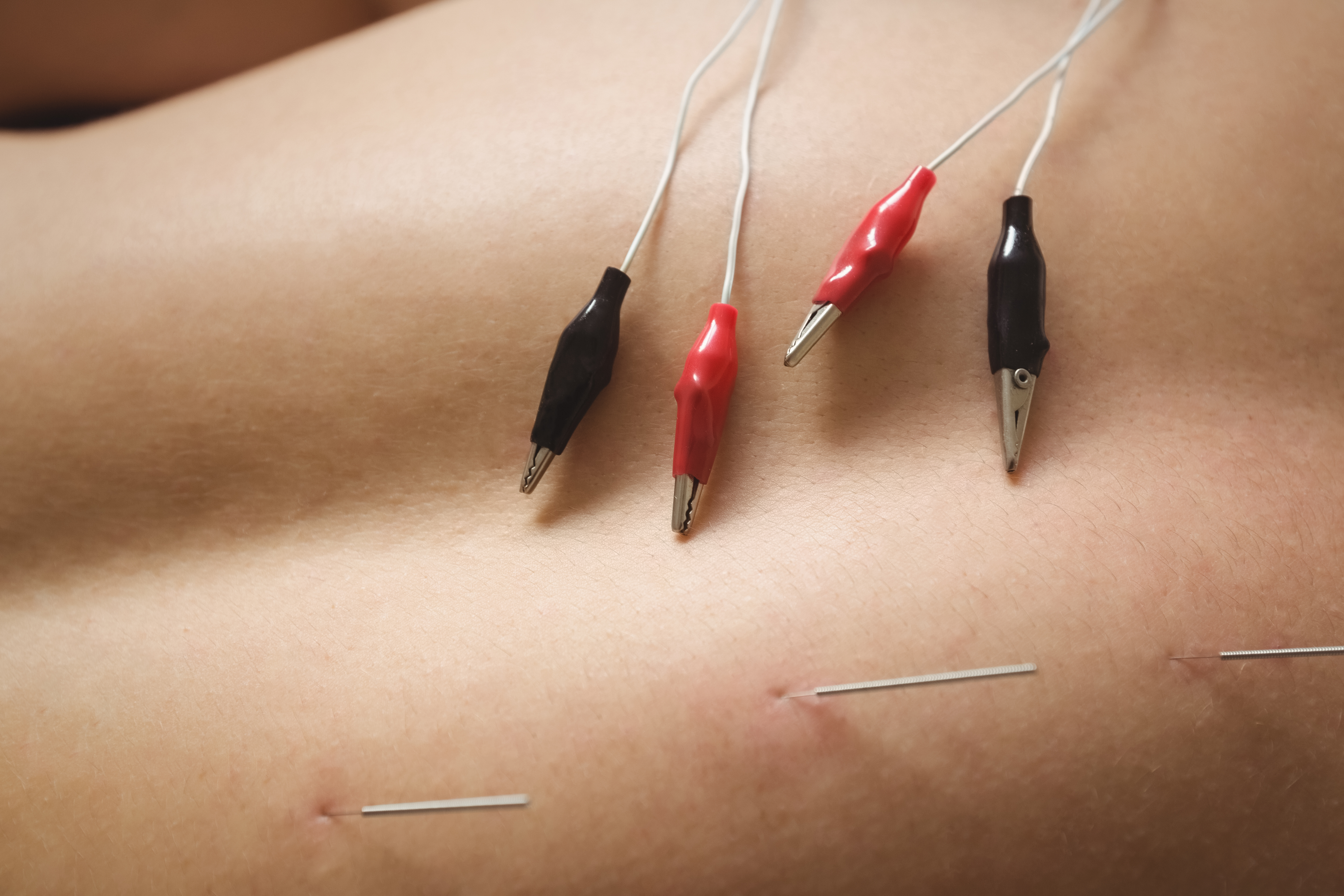 Fire Acupuncture